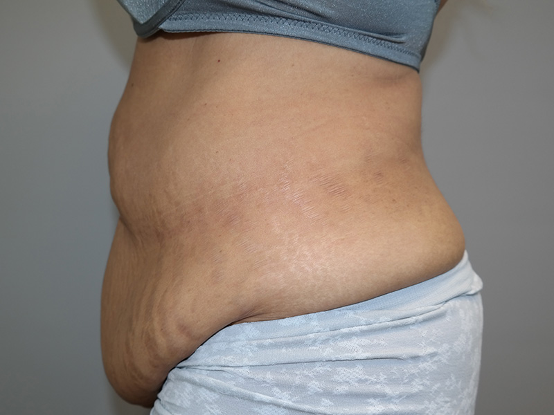 Tummy Tuck Before and After 06 | Sanjay Grover MD FACS