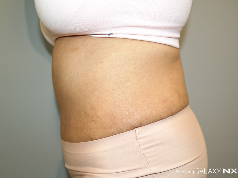 Tummy Tuck Before and After 06 | Sanjay Grover MD FACS