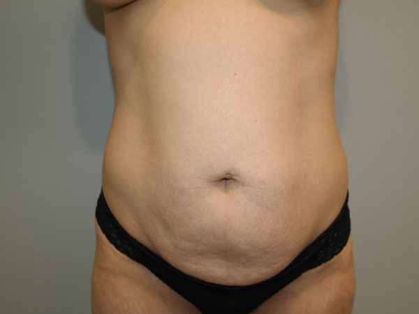 Tummy Tuck Before and After | Grover Aesthetics