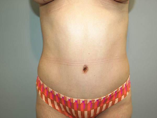 Tummy Tuck Before and After 07 | Sanjay Grover MD FACS