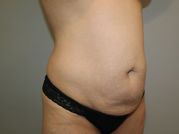 Tummy Tuck Before and After 07 | Sanjay Grover MD FACS