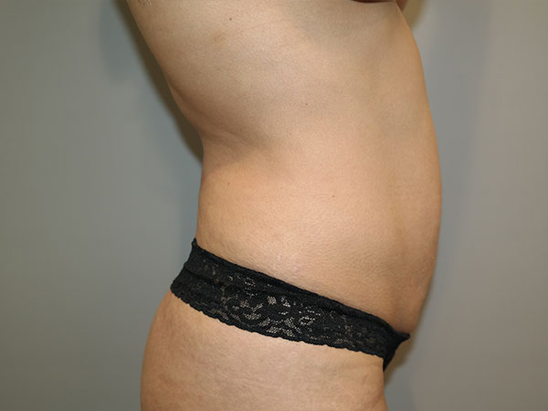 Tummy Tuck Before and After 07 | Grover Aesthetics