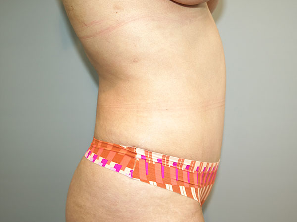 Tummy Tuck Before and After 07 | Grover Aesthetics