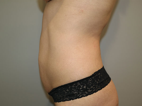 Tummy Tuck Before and After 07 | Grover Aesthetics