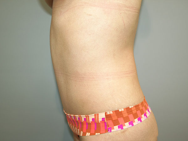 Tummy Tuck Before and After 07 | Grover Aesthetics