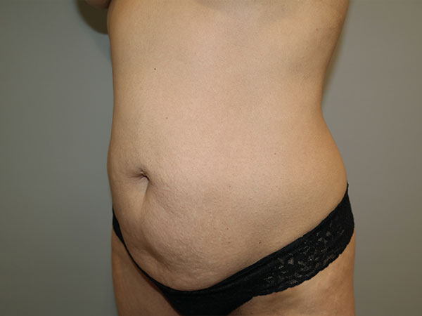 Tummy Tuck Before and After 07 | Sanjay Grover MD FACS