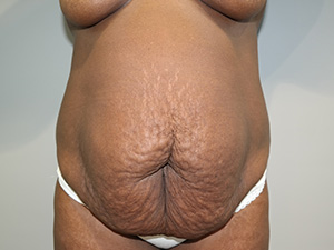 Tummy Tuck Before and After | Grover Aesthetics