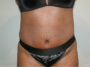 Tummy Tuck Before and After | Grover Aesthetics