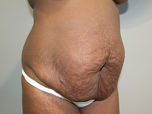Tummy Tuck Before and After 08 | Grover Aesthetics