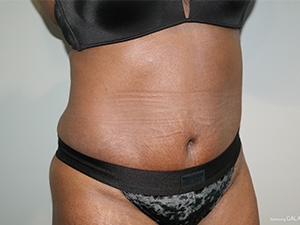 Tummy Tuck Before and After 08 | Grover Aesthetics