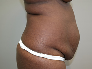Tummy Tuck Before and After 08 | Grover Aesthetics