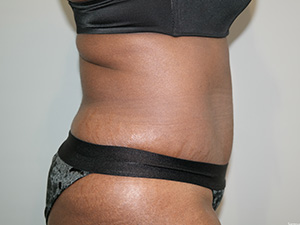 Tummy Tuck Before and After 08 | Grover Aesthetics