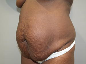 Tummy Tuck Before and After 08 | Grover Aesthetics