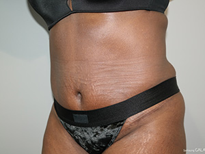 Tummy Tuck Before and After 08 | Grover Aesthetics