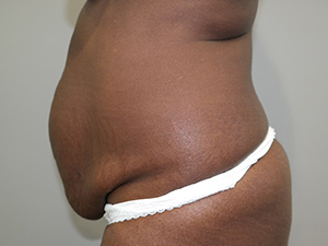 Tummy Tuck Before and After 08 | Grover Aesthetics