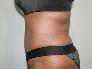 Tummy Tuck Before and After 08 | Grover Aesthetics