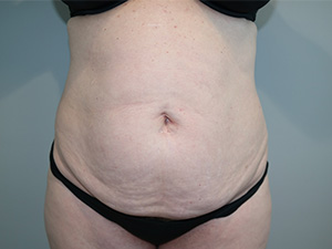 Tummy Tuck Before and After | Grover Aesthetics