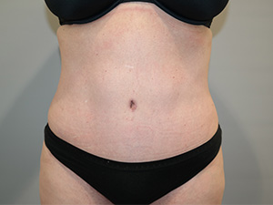 Tummy Tuck Before and After | Grover Aesthetics