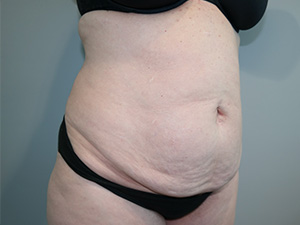 Tummy Tuck Before and After 09 | Sanjay Grover MD FACS