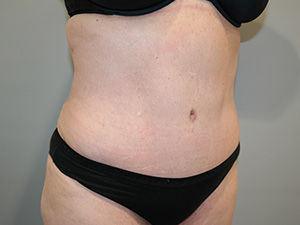 Tummy Tuck Before and After 09 | Sanjay Grover MD FACS