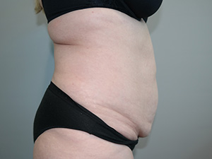 Tummy Tuck Before and After 09 | Sanjay Grover MD FACS