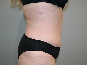 Tummy Tuck Before and After 09 | Sanjay Grover MD FACS