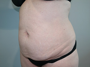 Tummy Tuck Before and After 09 | Sanjay Grover MD FACS