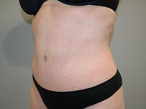 Tummy Tuck Before and After 09 | Sanjay Grover MD FACS