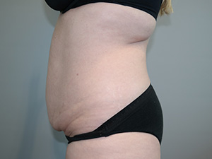 Tummy Tuck Before and After 09 | Sanjay Grover MD FACS