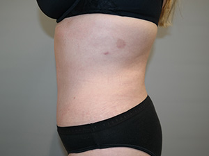 Tummy Tuck Before and After 09 | Sanjay Grover MD FACS