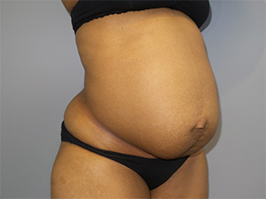 Tummy Tuck Before and After 10 | Sanjay Grover MD FACS