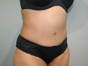 Tummy Tuck Before and After 10 | Sanjay Grover MD FACS