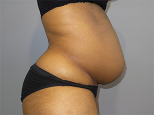 Tummy Tuck Before and After 10 | Sanjay Grover MD FACS