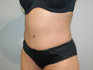 Tummy Tuck Before and After 10 | Sanjay Grover MD FACS