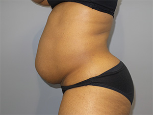 Tummy Tuck Before and After 10 | Sanjay Grover MD FACS