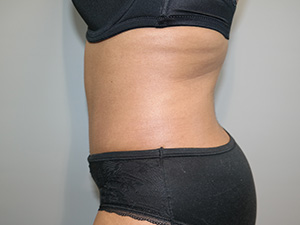 Tummy Tuck Before and After 10 | Sanjay Grover MD FACS