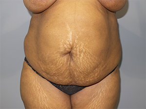 Tummy Tuck Before and After 103 | Sanjay Grover MD FACS