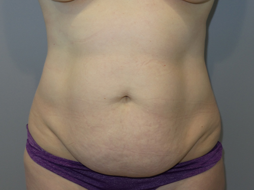 Tummy Tuck Before and After | Grover Aesthetics