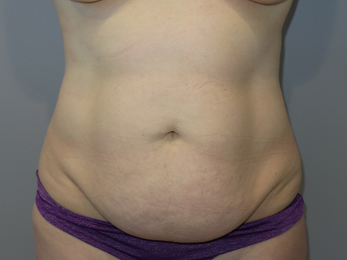 Tummy Tuck Before and After 106 | Sanjay Grover MD FACS