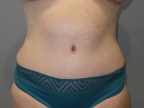 Tummy Tuck Before and After | Grover Aesthetics
