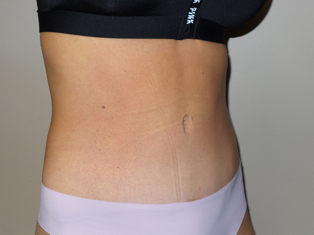 Tummy Tuck Before and After 100 | Grover Aesthetics