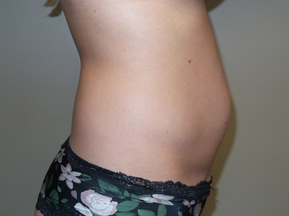 Tummy Tuck Before and After 100 | Grover Aesthetics
