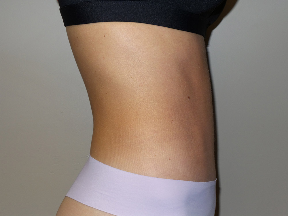 Tummy Tuck Before and After 100 | Grover Aesthetics