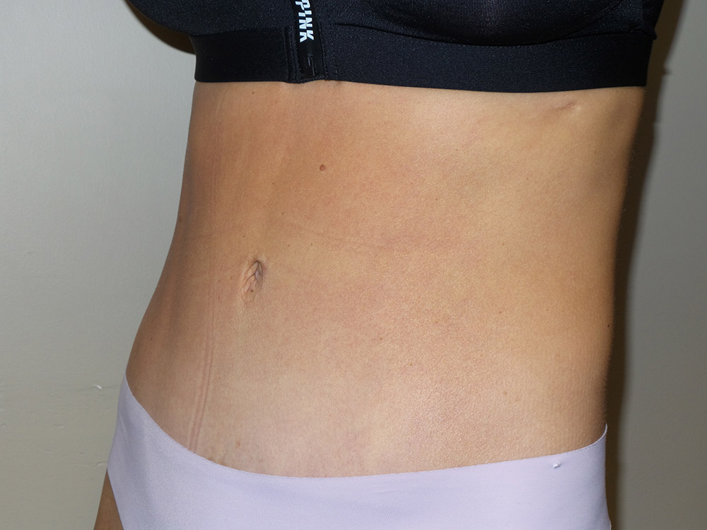 Tummy Tuck Before and After 100 | Grover Aesthetics