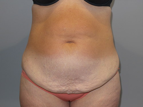 Tummy Tuck Before and After | Grover Aesthetics