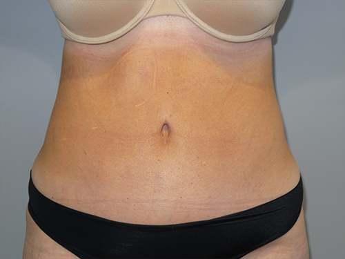 Tummy Tuck Before and After | Grover Aesthetics