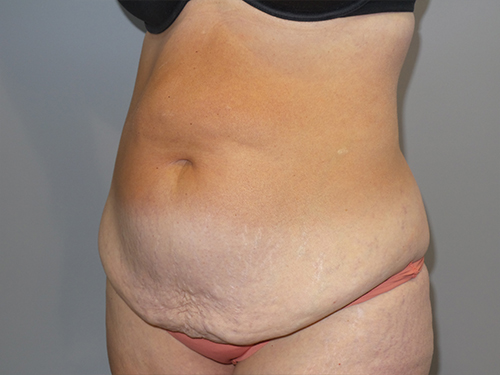 Tummy Tuck Before and After 101 | Grover Aesthetics