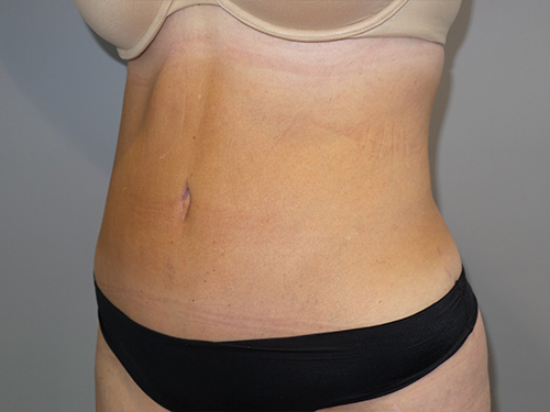 Tummy Tuck Before and After 101 | Grover Aesthetics