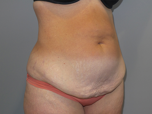 Tummy Tuck Before and After 101 | Sanjay Grover MD FACS