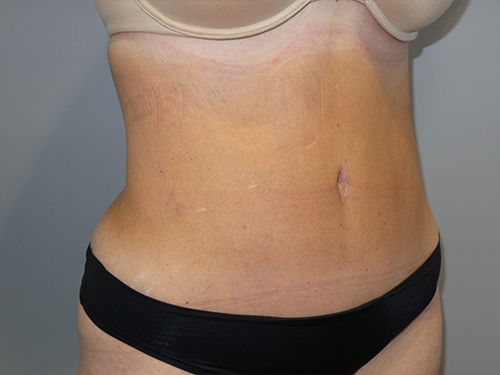 Tummy Tuck Before and After 101 | Grover Aesthetics